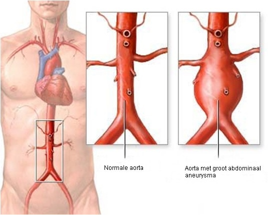 AAA